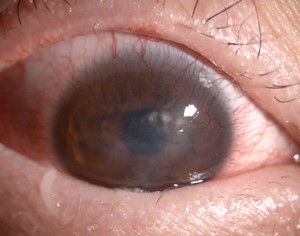 공막렌즈의 구조 및 적용 질환 : 네이버 블로그