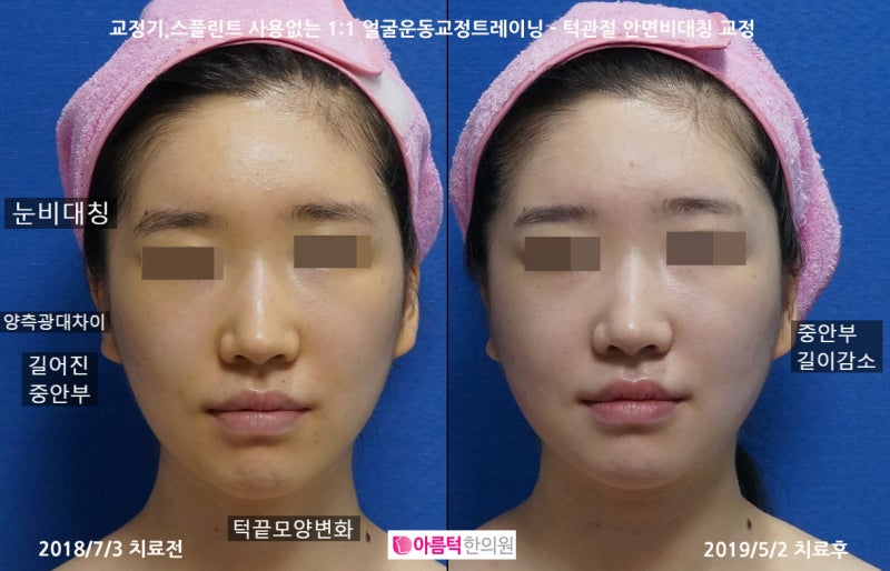 안면 비대칭 수술에 대한 자세한 양악 수술 리뷰를 살펴보겠습니다. 7