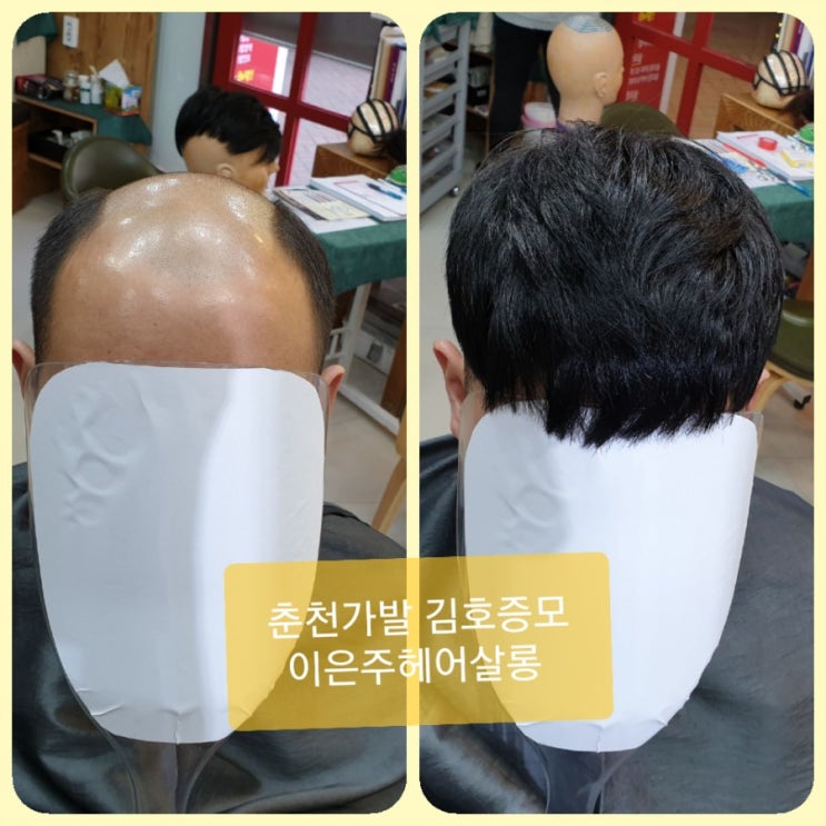  춘천가발 김호증모 남자맞춤가발 샌드위치기법 고정식가발 피팅 합니다