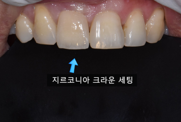  앞니 벌어짐 치료방법(지르코니아 크라운/레진/치은 성형술)