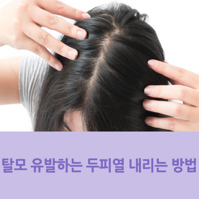  탈모 유발하는 두피열 내리는 방법