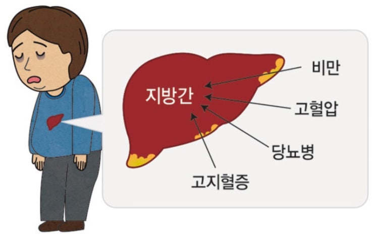  중년들이 꼭 신경써야 할 지방간에 좋은 음식 7가지