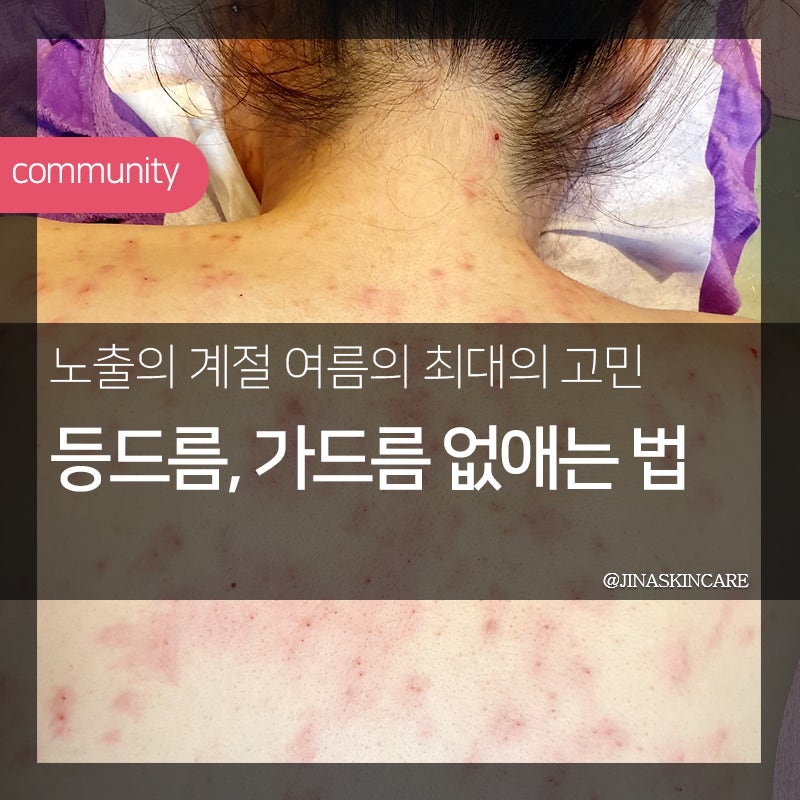 등의 여드름, 뾰루지, 모공각화증 킹스톤으로 해결 가능 12