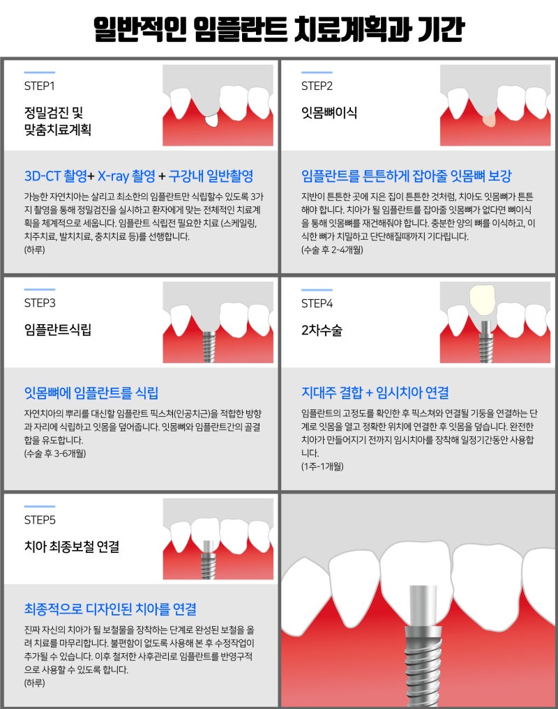 임플란트 치료기간 단축 꿀팁 공유