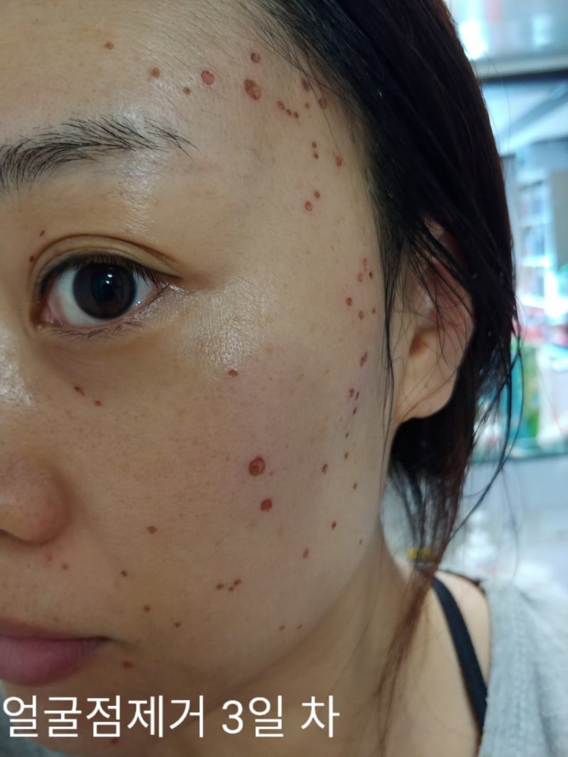 대구 얼굴점 제거, 다양한 형태로 위치하는 2