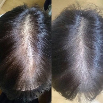 헤어 발모제 출산 후 대책 없음 헤어 2