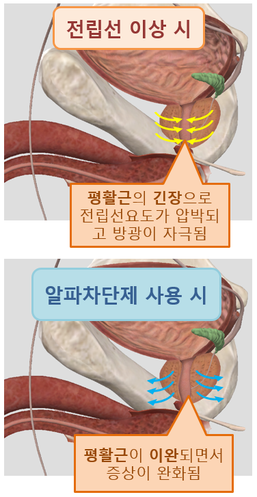  만성전립선염의 치료- 알파 차단제