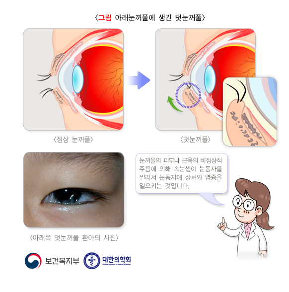 아이 속눈썹이 눈을 자꾸 찌를 때 덧눈꺼풀(부안검) 교정술 보장하는 태아보험 선천이상수술 특약