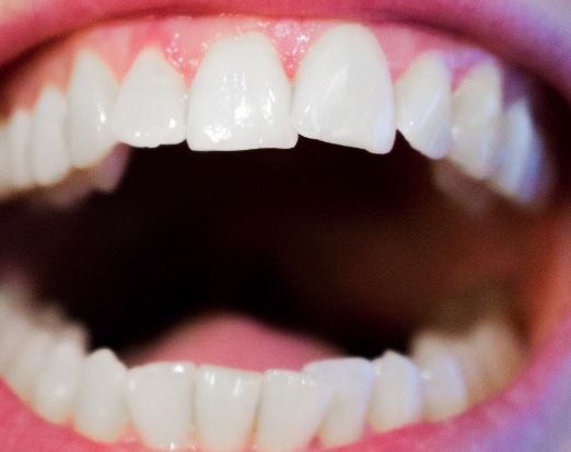 앞니를 치과에서 치아성형을 할까? 치아교정을 할까?