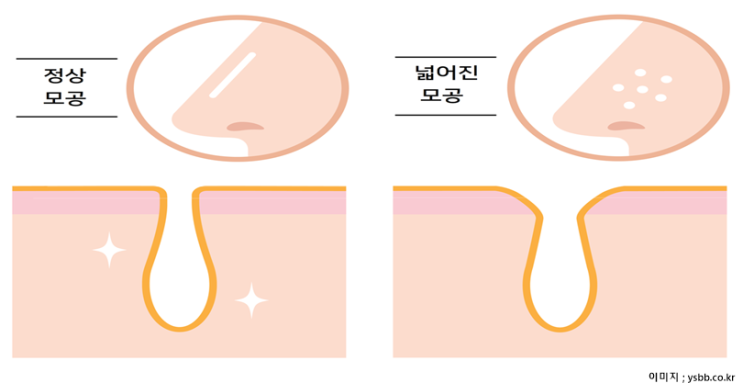  여름이면 커지는 모공, 좁히기 기초관리