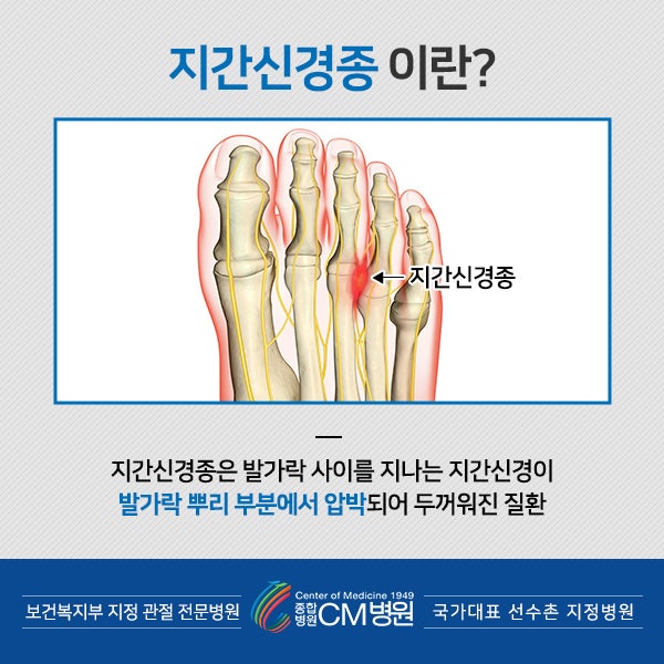 지간신경종 발가락 통증부위, 원인, 치료방법 5
