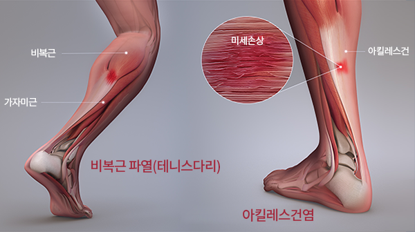 갑작스런 종아리 근육 사용, 비복근 파열 부른다!(테니스 다리/Tennis Leg) : 네이버 블로그