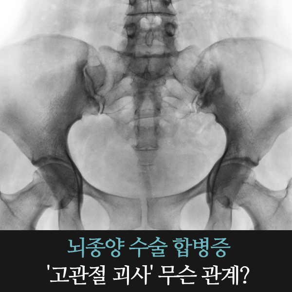  뇌종양 수술 합병증 '고관절 괴사' 무슨 관계?