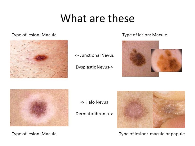 Macule Vs Papule
