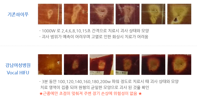 HIFU로 자궁근종을 치료하는 방법을 알려드리겠습니다!