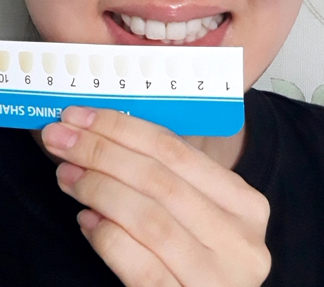 치아미백기 추천 :  플라스큐 플라즈마 치아미백기 한달 사용후기