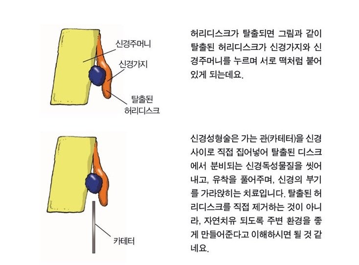 허리 디스크 치료법 : ‘허리 내시경 2
