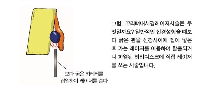 허리 디스크 치료법 : ‘허리 내시경 8