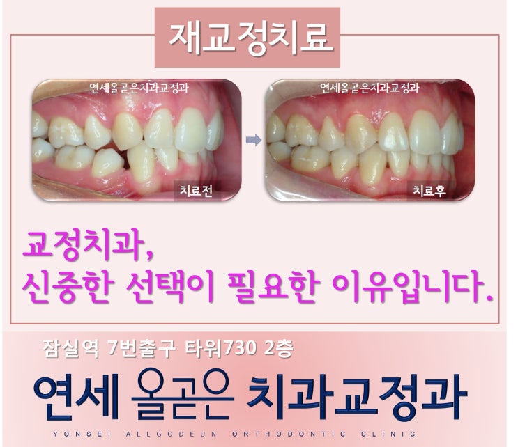  재교정치료도 송파구치아교정 잠실역 연세올곧은치과교정과입니다.