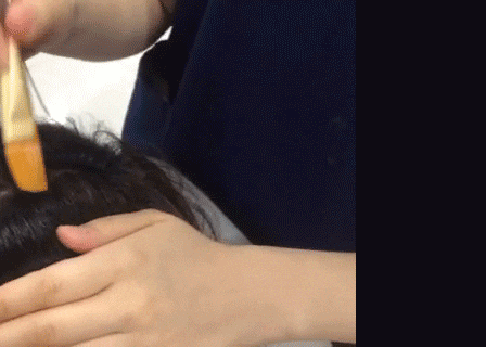  인천탈모 연세모벨르 [meso][mts]탈모치료와 관리
