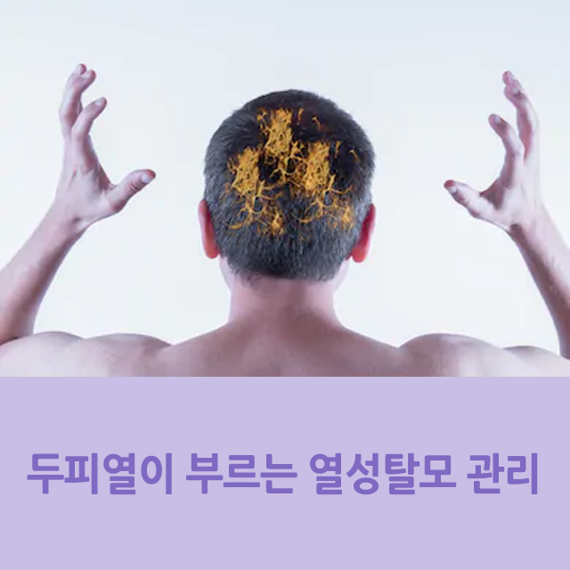 두피열이 부르는 열성탈모 관리하기