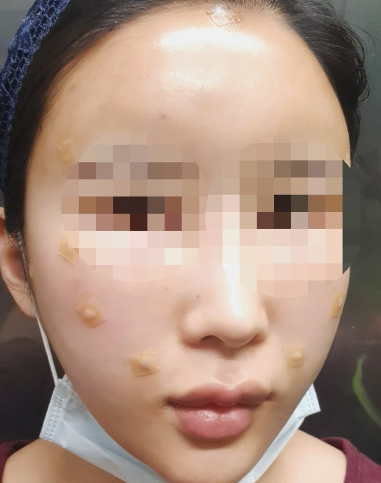  [서울/신사역] 포에버성형외과 풀페이스지방이식 일주일차후기2