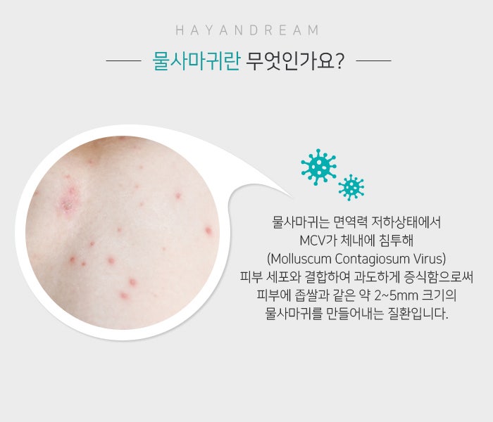 <용인물사마귀> 피부에 생긴 물사마귀 10