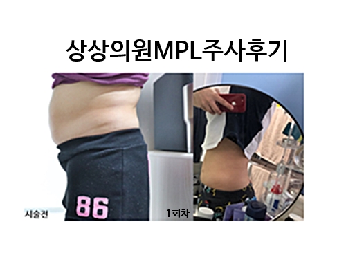 MPL주사  1회차후기(Feat.상상의원 명동점) 연예인다이어트 복부MPL