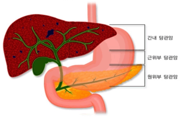  담도암증상, 담도암에좋은음식 추천
