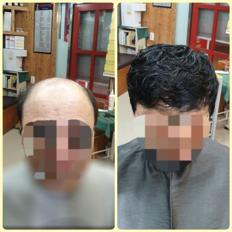  남자 반전두 맞춤가발 피팅 합니다