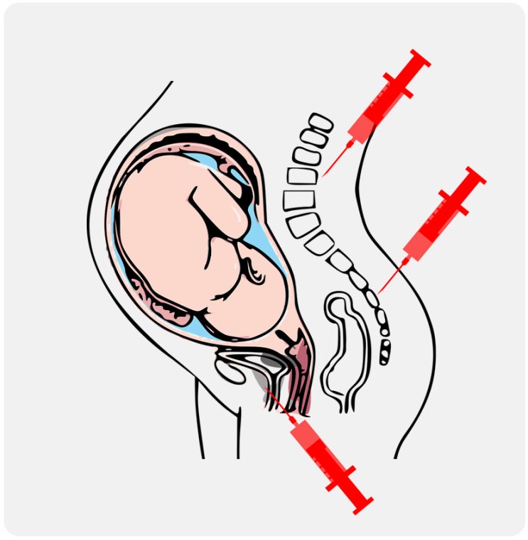  [FAQ] 김보연산부인과에서는 어떤 마취를 하나요?
