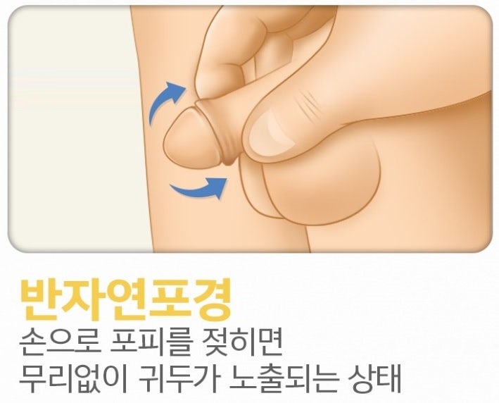 포경수술과 처녀막재생술은 필요악이다 : 네이버 블로그 포경수술과 처녀막재생술은 필요악이다 : 네이버 블로그