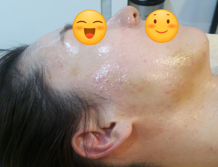  큰일 났어요 얼굴 피부가 이상해요 스킨보톡스