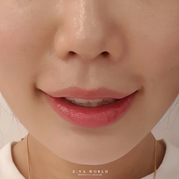  부산 거미스마일 교정 보톡스 솔직 후기