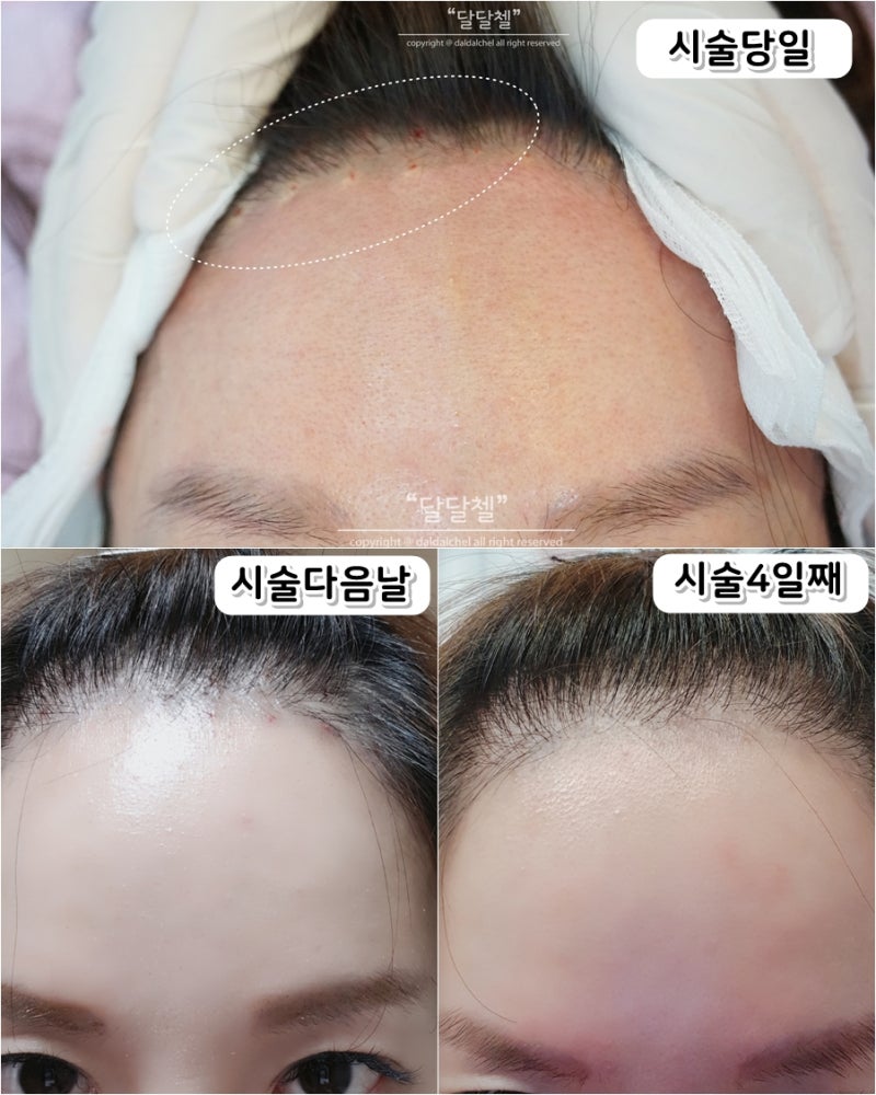 처진 볼살 리프팅 쓰리젯 (에어젯2+쓰리딥)후기