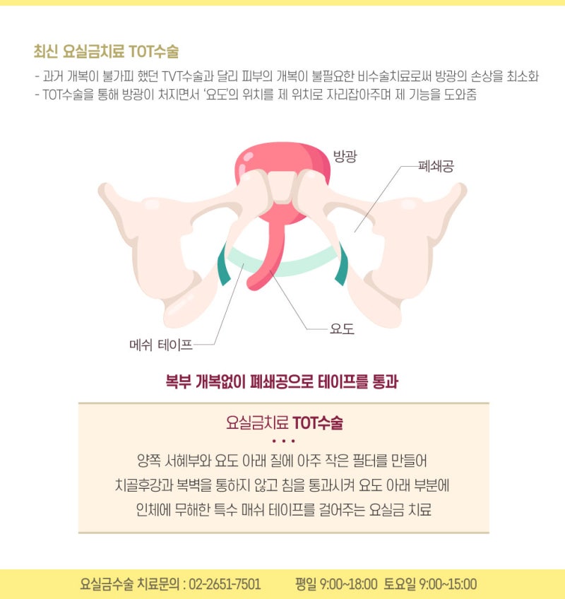 요실금 수술을 하고도 곧 재수술한 환자의 특징? 4