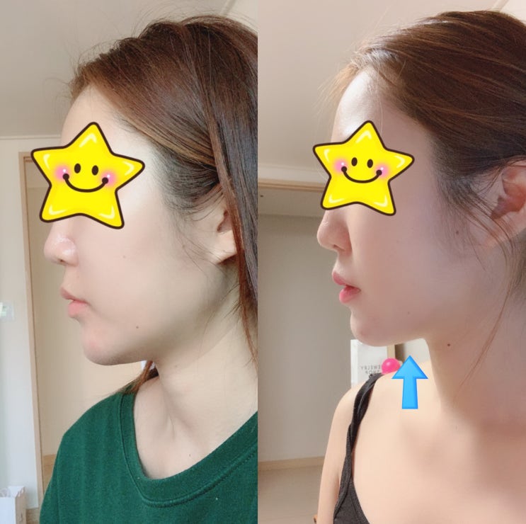  얼굴 리프팅, 지니블링 시바산 그라비텐션 엄지척 !!