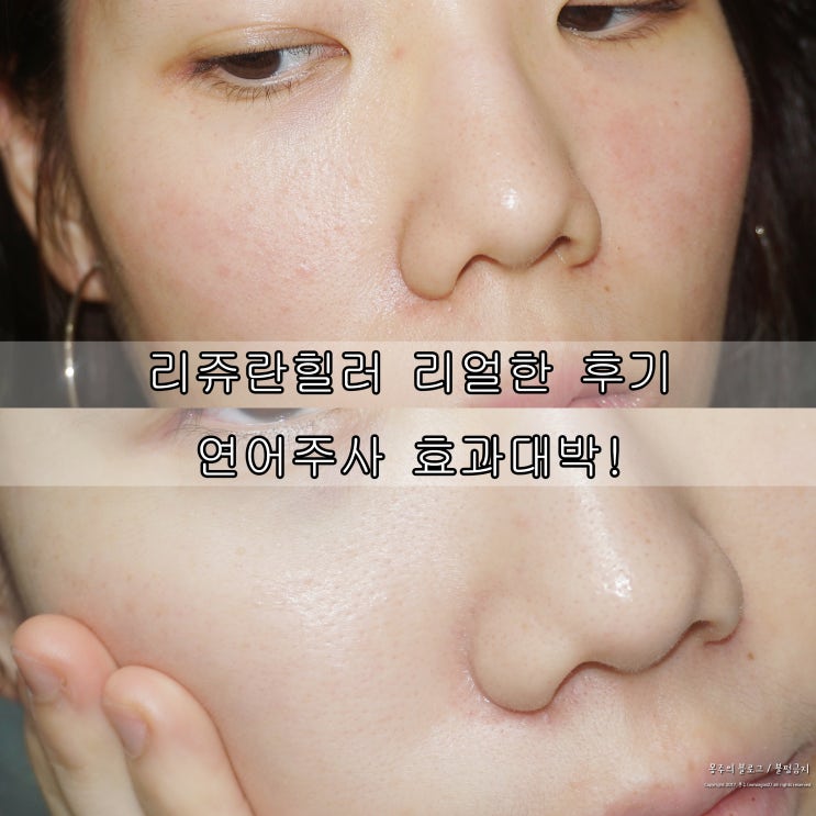  리쥬란힐러 리얼한 후기 연어주사 효과 대박!