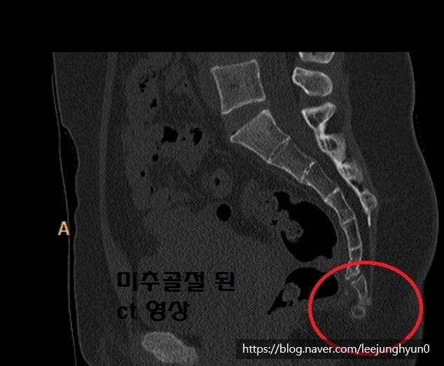 주차장에서 꼬리뼈가 부러졌습니다. 보험?