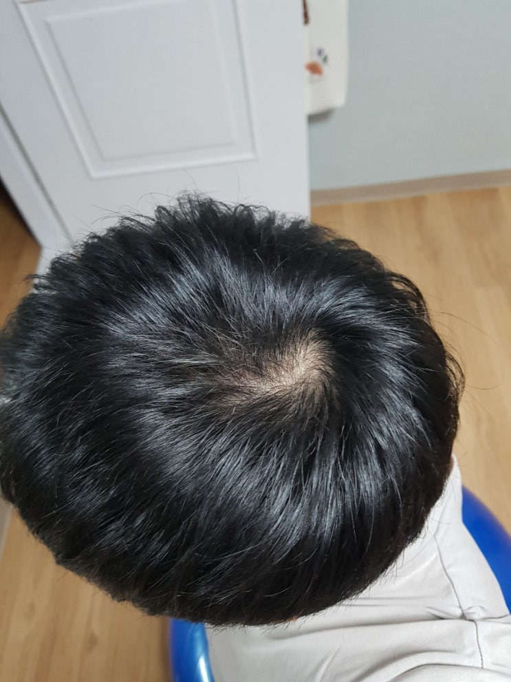  탈모치료 먹는약 바르는약 탈모샴푸까지 실제후기