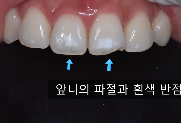 치아 흰색 반점 레진치료/치아사이 충치치료