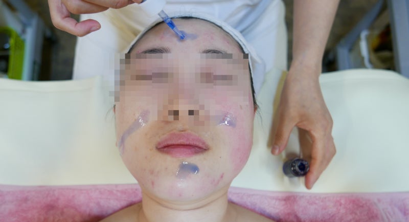 남포동 스킨케어 모빌리티 쎄틱의 안정적인 여드름 관리 5