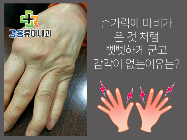  손가락 감각 마비 온 것 처럼 저림 증상 심해질땐!!