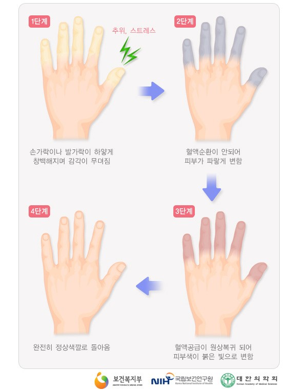  레이노병이 뭔가요?
