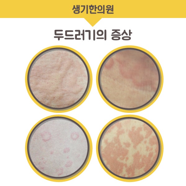 Yeongdeungpo 두드러기 클리닉은 신체 기능 감소로 보충되어야합니다.