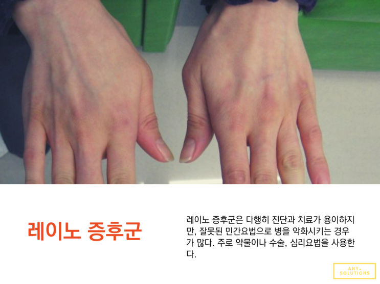  조민아 씨가 걸렸다는 레이노병