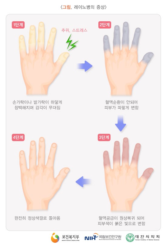  레이노 병?레이노 현상??(창원중국어,마산중국어,합성동중국어)