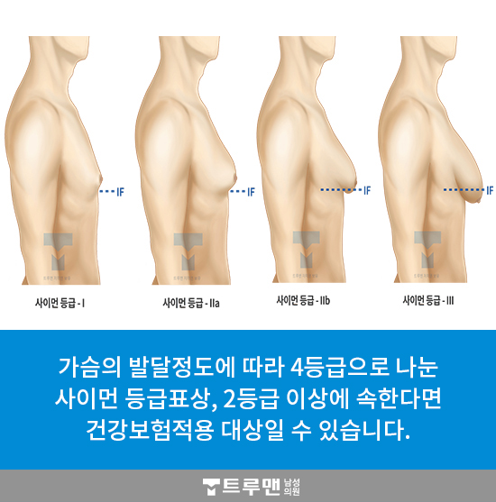 여성형 유방, 가성 여성형 유방? 여성형 유방? 궁금하시면 계속 읽어보세요.