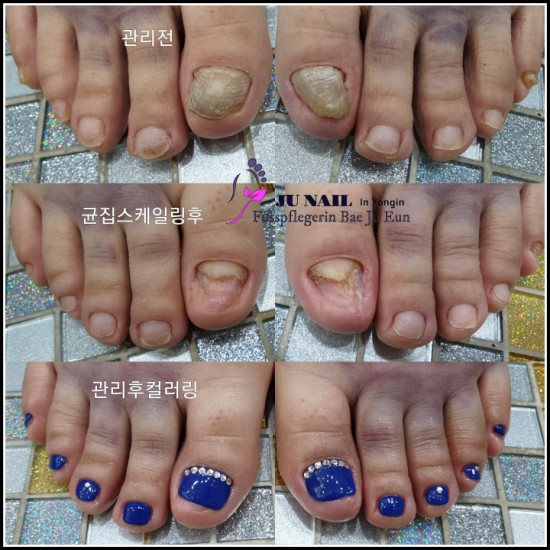 변형된발톱때문에 단한번도 샌들을 못신어봤어요./분당용인수원수지보정동백죽전동/주네일/무좀파고드는발톱전문네일샵 변형된발톱때문에 단한번도 샌들을 못신어봤어요./분당용인수원수지보정동백죽전동/주네일/무좀파고드는발톱전문네일샵