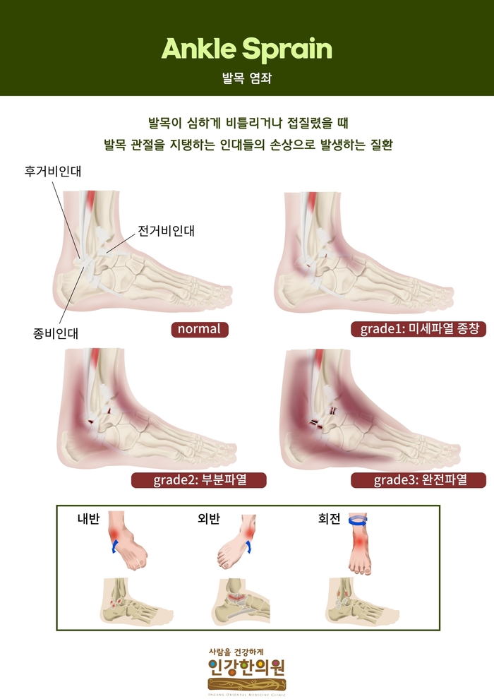  [잠실한의원]발목 염좌는 역시 한방 치료가 좋습니다